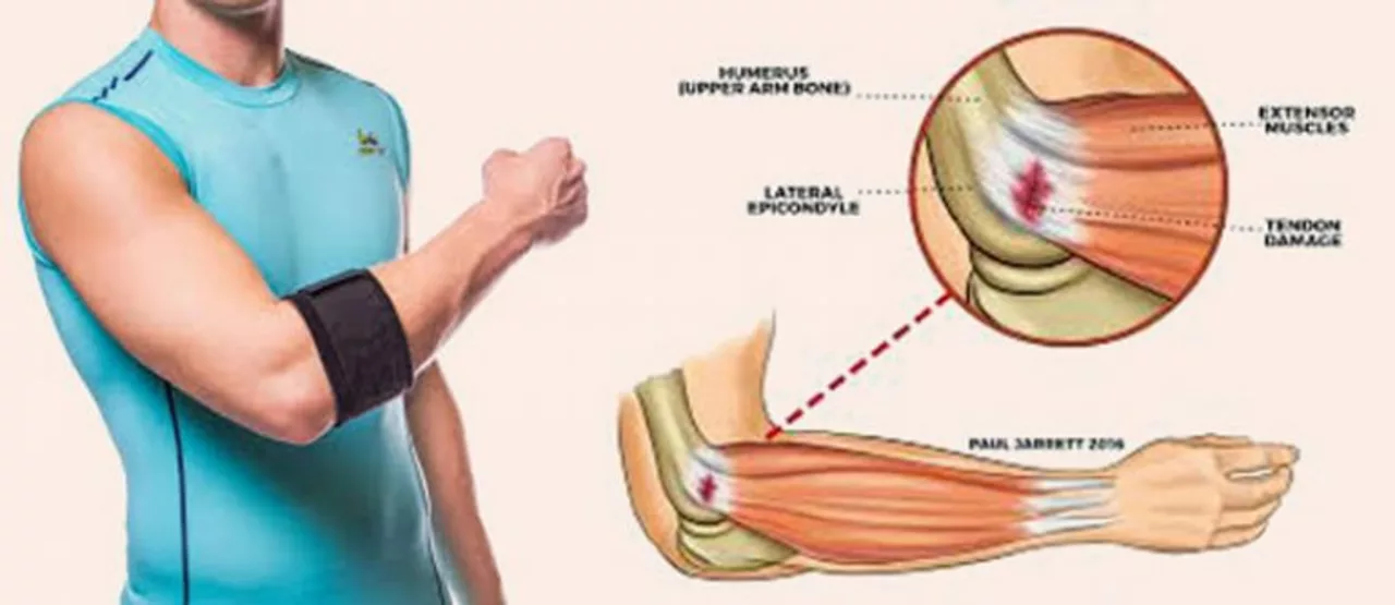Does tennis elbow affect guitar playing?